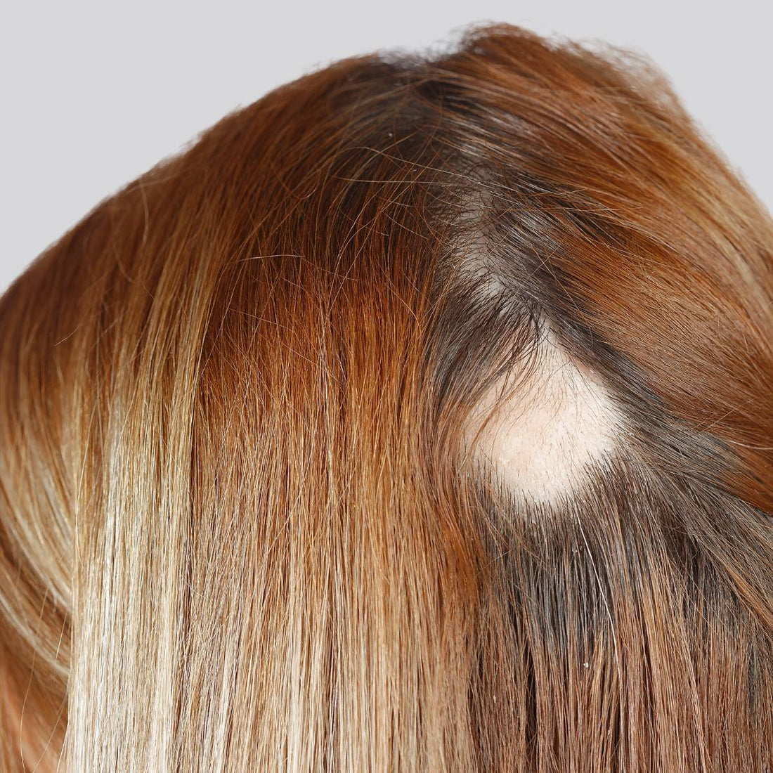 Understanding Trichotillomania and Skin Picking Disorder: How Fidgets Offer Solace in 2026